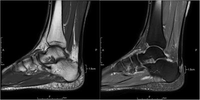 Successful restoration of failed Achilles tendon surgery with semitendinosus and gracilis tendon graft: a case report